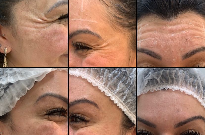 Tratamento com botox